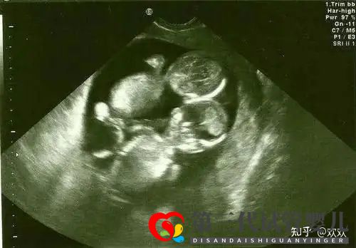 多年不孕,成都三代试管一次成功双胎男宝(图5) 多年不孕,成都三代试管一次成功双胎男宝(图5)