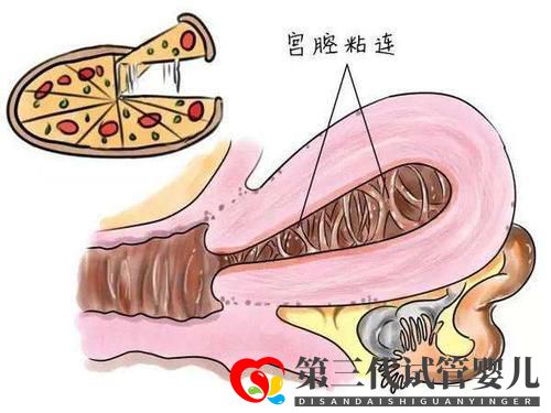 子宫粘连可以做试管婴儿吗?成功率高不高?(图1) 子宫粘连可以做试管婴儿吗?成功率高不高?(图1)