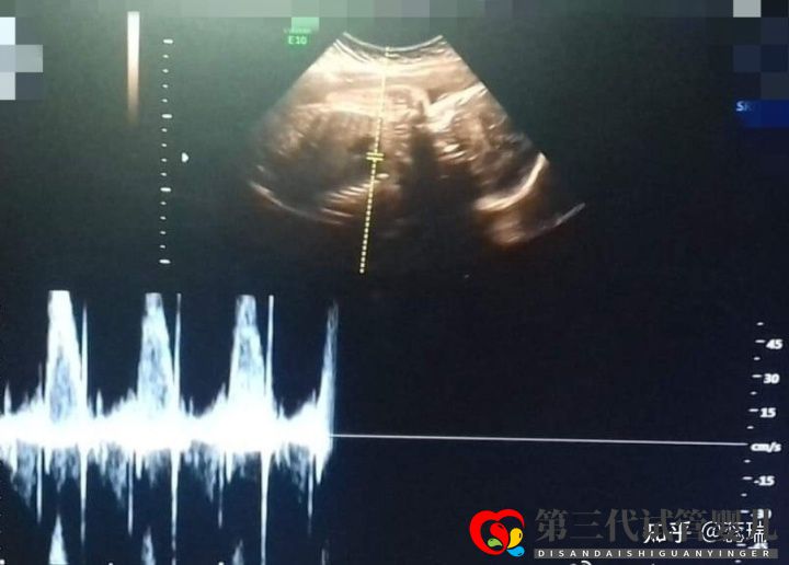我终于怀上了辛酸三代试管经历大家接好孕(图3) 我终于怀上了辛酸三代试管经历大家接好孕(图3)