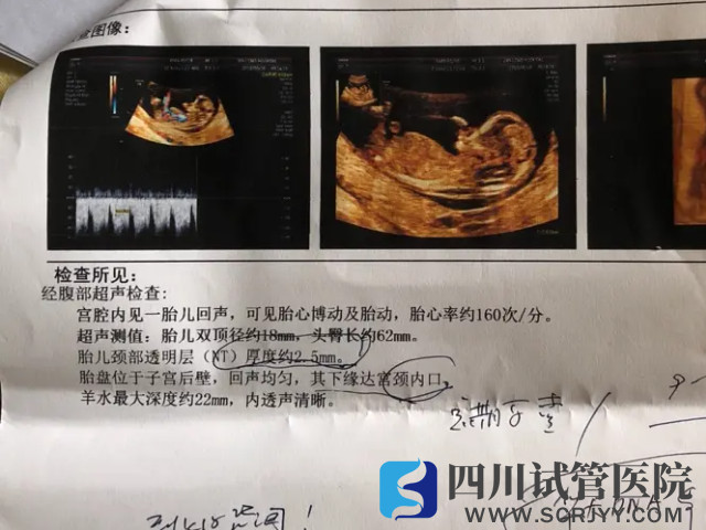 NT判断生男生女的方法