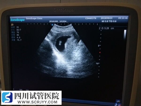 移植囊胚为什么更容易生儿子